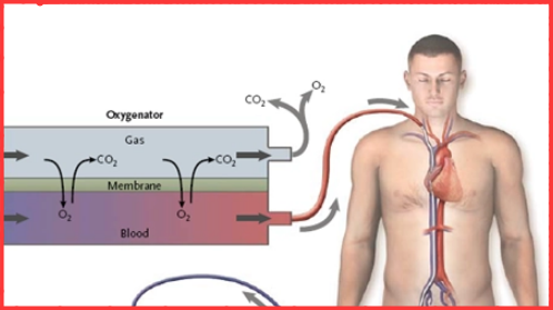 叶克膜(ECMO)是一种什么技术？