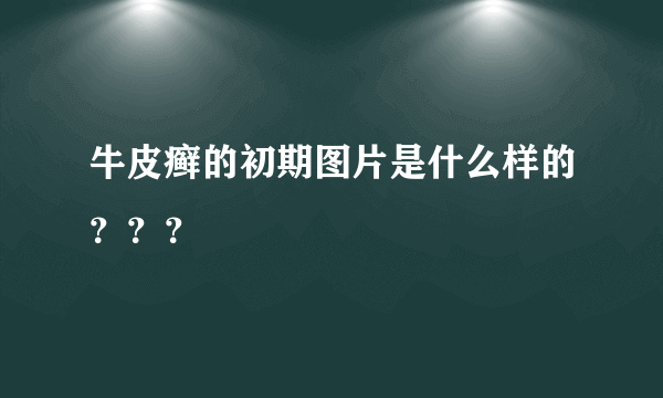 牛皮癣的初期图片是什么样的？？？