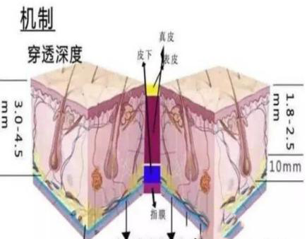 电波拉皮有没有副作用？