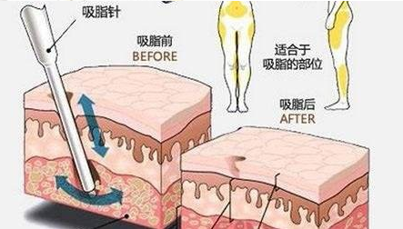 北京做一次吸脂多少钱？