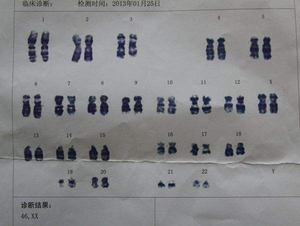 如何看染色体核型分析结果?