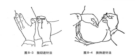 针刺方法有哪些？