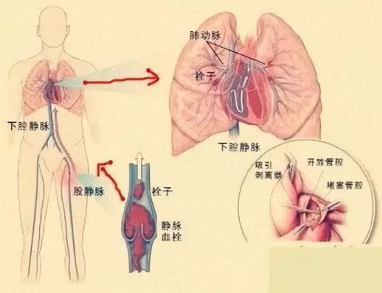 lung怎么读？