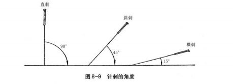 针刺方法有哪些？