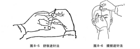 针刺方法有哪些？