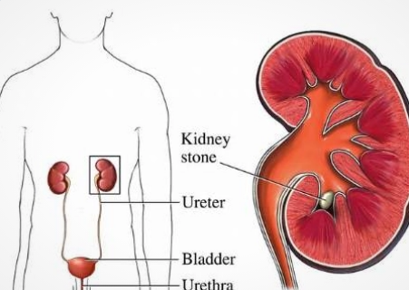 肾结石是是什么原因引起的？