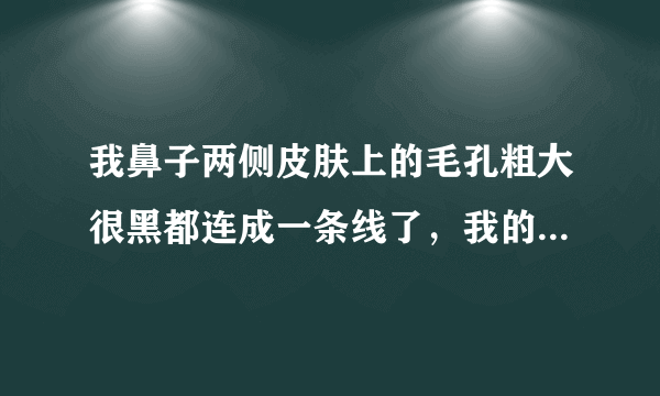 我鼻子两侧皮肤上的毛孔粗大很黑都连成一条线了，我的眼底和整个鼻子上、额头上有油质粒，我该怎么办？